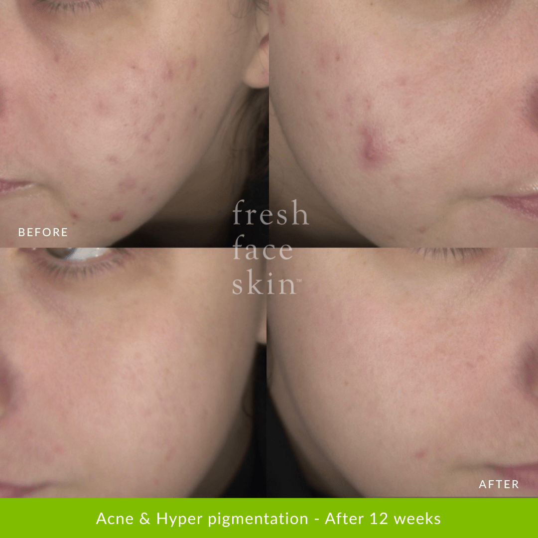 Hydrate &amp; Renew Pack - Fresh Face Skin