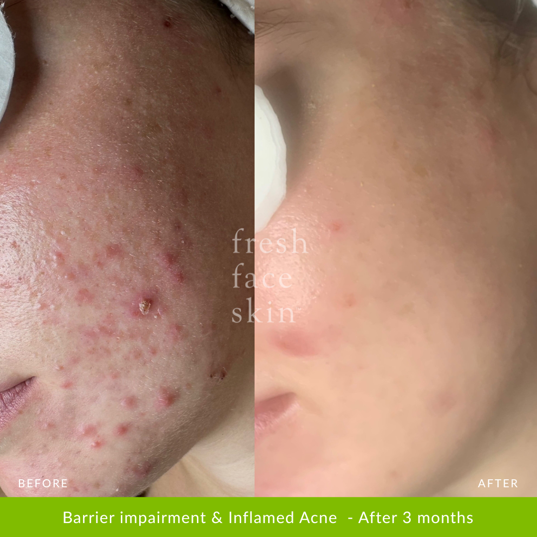 Acne Clearing Pack