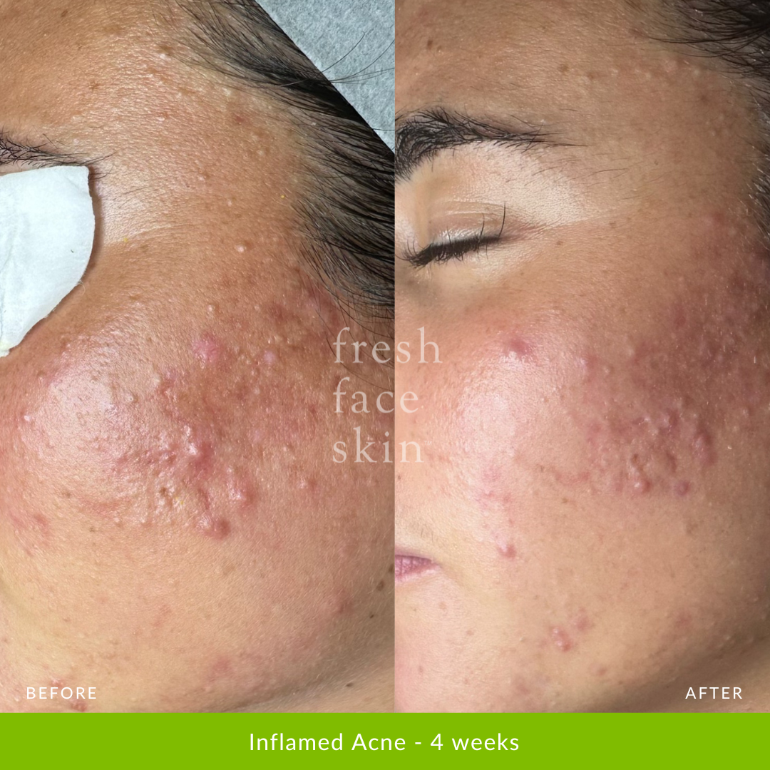 Acne Clearing Pack
