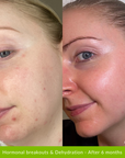 Reverser Treatment