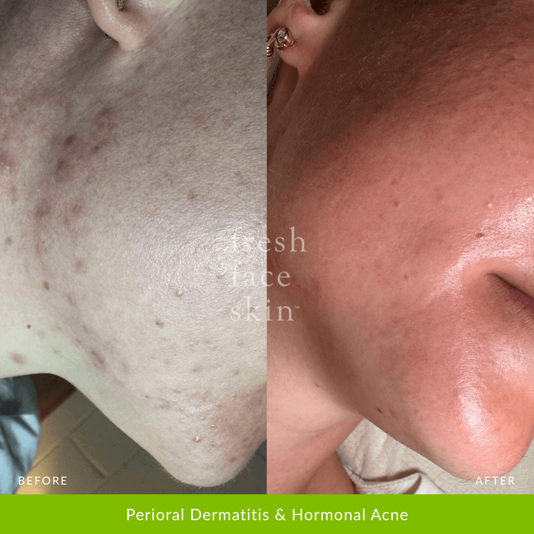 Skin Barrier Repair Pack - Fresh Face Skin