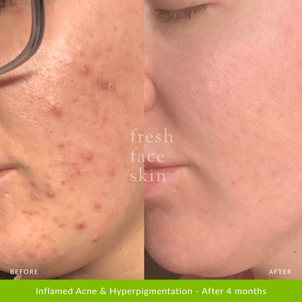 Healer Cleanser - Fresh Face Skin