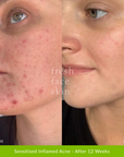 Reverser Treatment