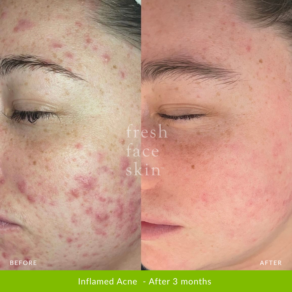Inflamed Acne  - After 3 months