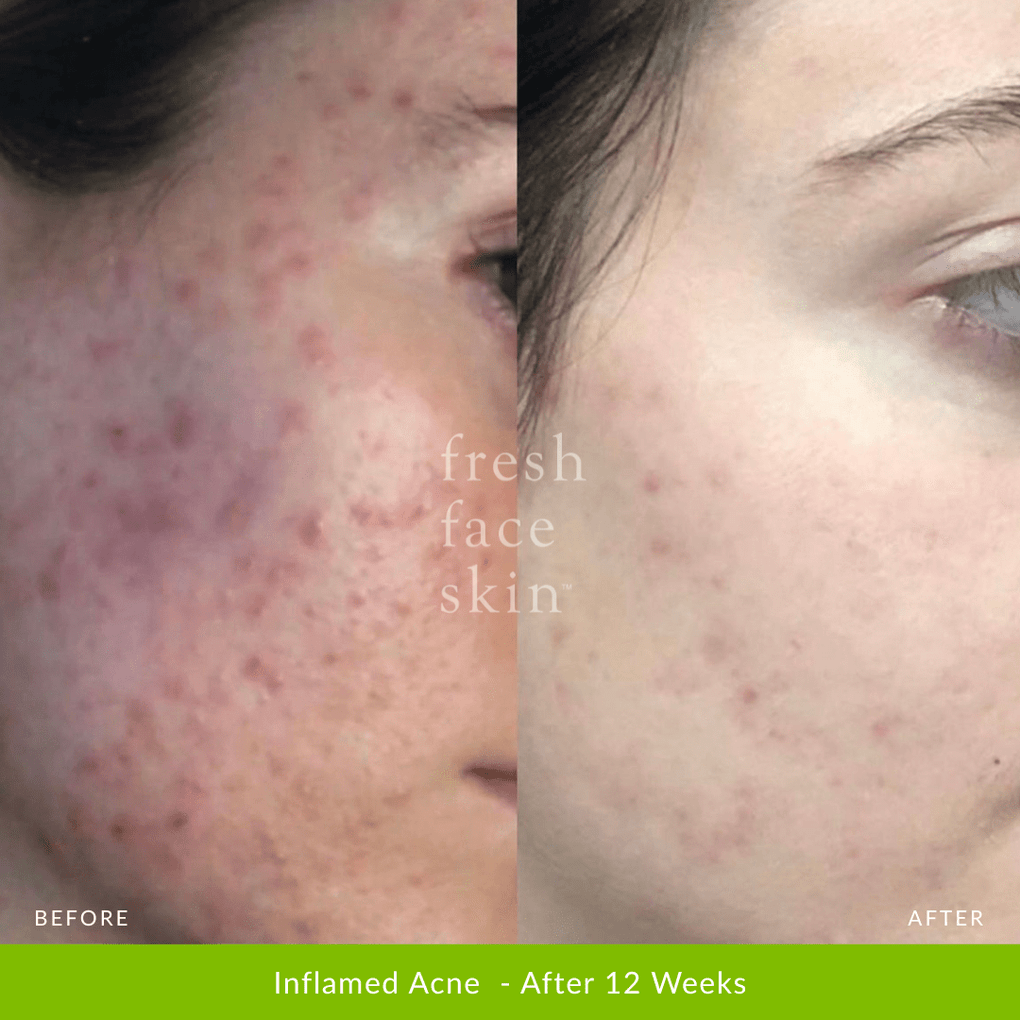 Acne Clearing Pack - Fresh Face Skin