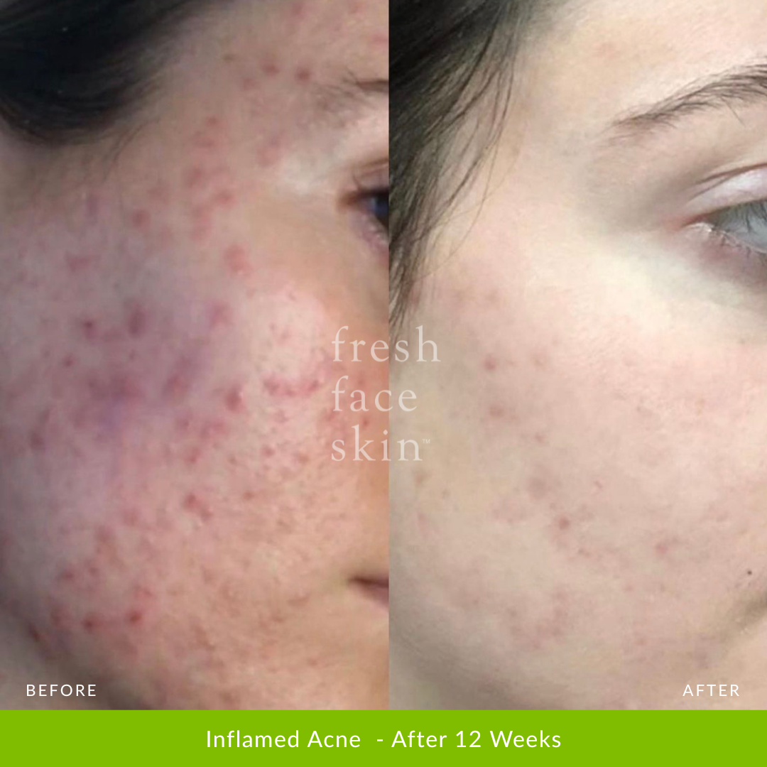 Acne Clearing Pack