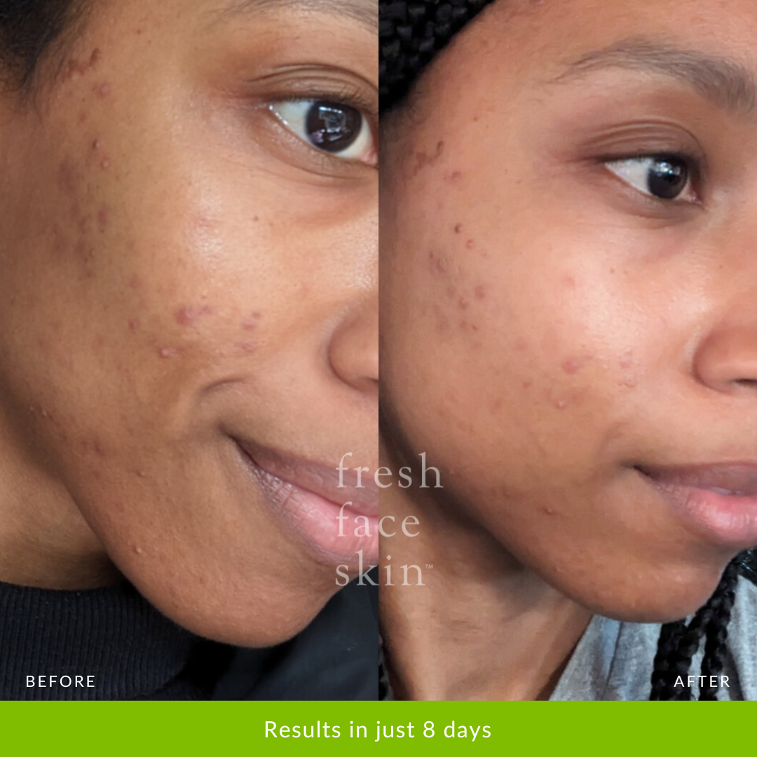 Reduced Pores, reduction of pigmentation