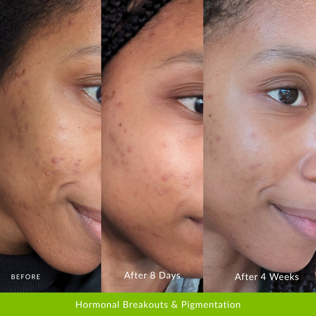 Hormonal Breakouts & Pigmentation