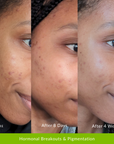 Reverser Treatment