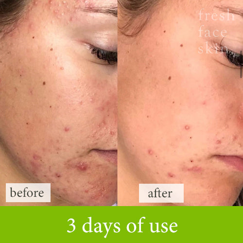 Skincare results in 3 days with fresh face skin treatments