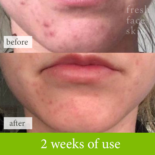 just 2 weeks of fresh face healer treatment