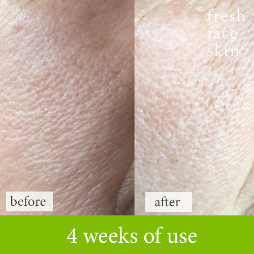 Reduce pore size size with no harsh chemicals