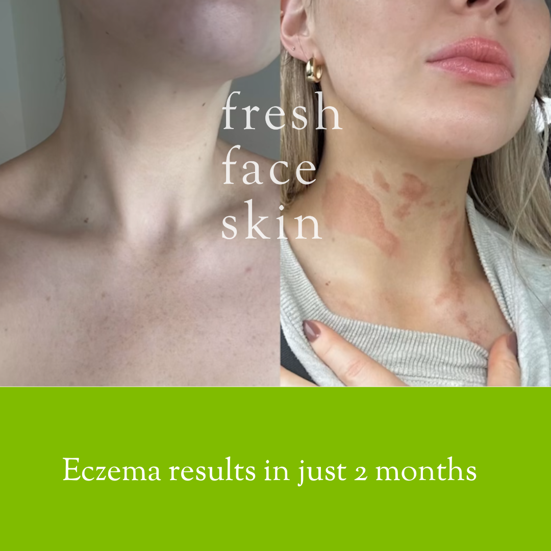 Eczema results with no steroid cream
