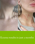 Eczema results with no steroid cream