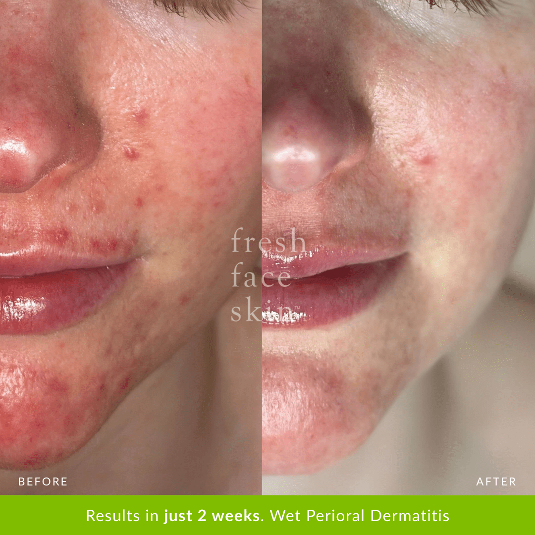 2 weeks with Barrier pack - wet dermatitis