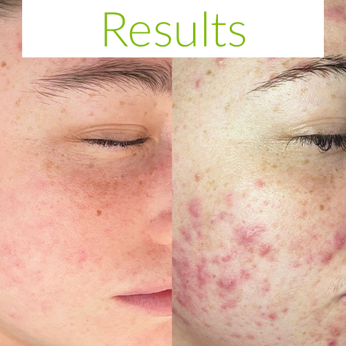 fresh face skin real results acne treatment