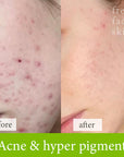 Acne and Hyper pigment treatment