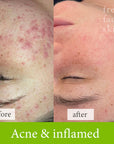 Acne and inflamed treatment before and after