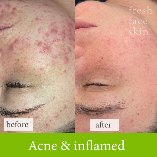 Acne and inflamed treatment before and after