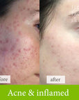 Acne and inflamed skin treatment