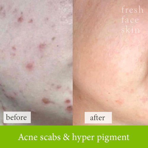 Acne scabs &amp; hyper pigment treatment