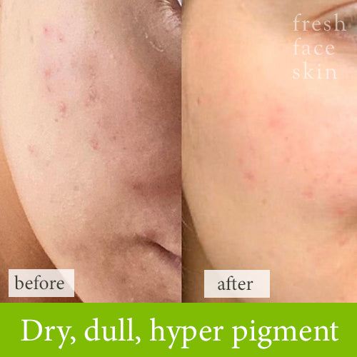 Dry, dull and hyper pigment treatmtent