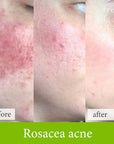 Rosacea acne treatment before and after