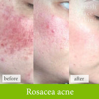 Rosacea acne treatment before and after