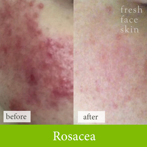 Rosacea treatment