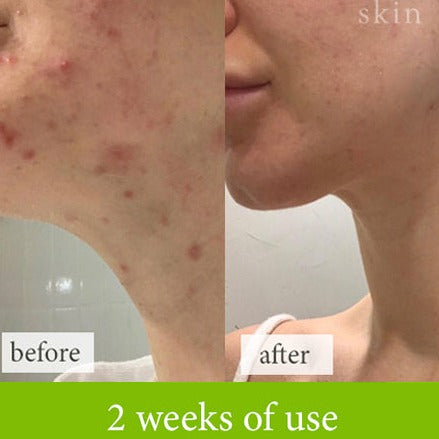 Acne and inflamed skin natural treatment