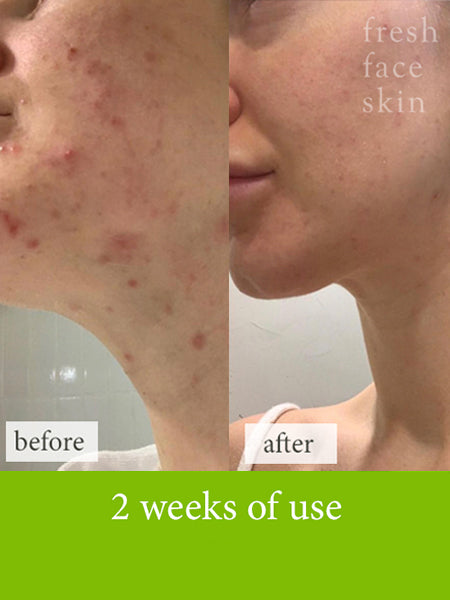 Acne and inflamed skin natural treatment